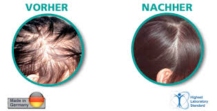 Hairoxol –  für das Haarwachstum - bestellen – Nebenwirkungen – erfahrungen